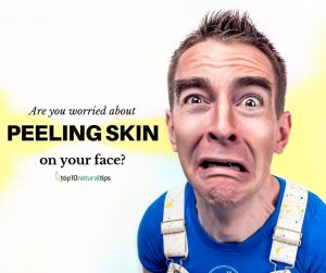 peeling skin on face