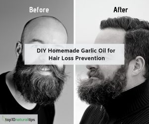 garlic oil to treat hair loss
