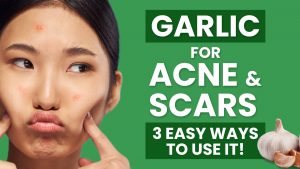garlic for acne scars